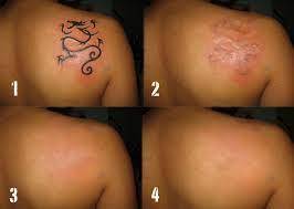 Tattoo Remover Cream In Krugersdorp+27 81 850 2816